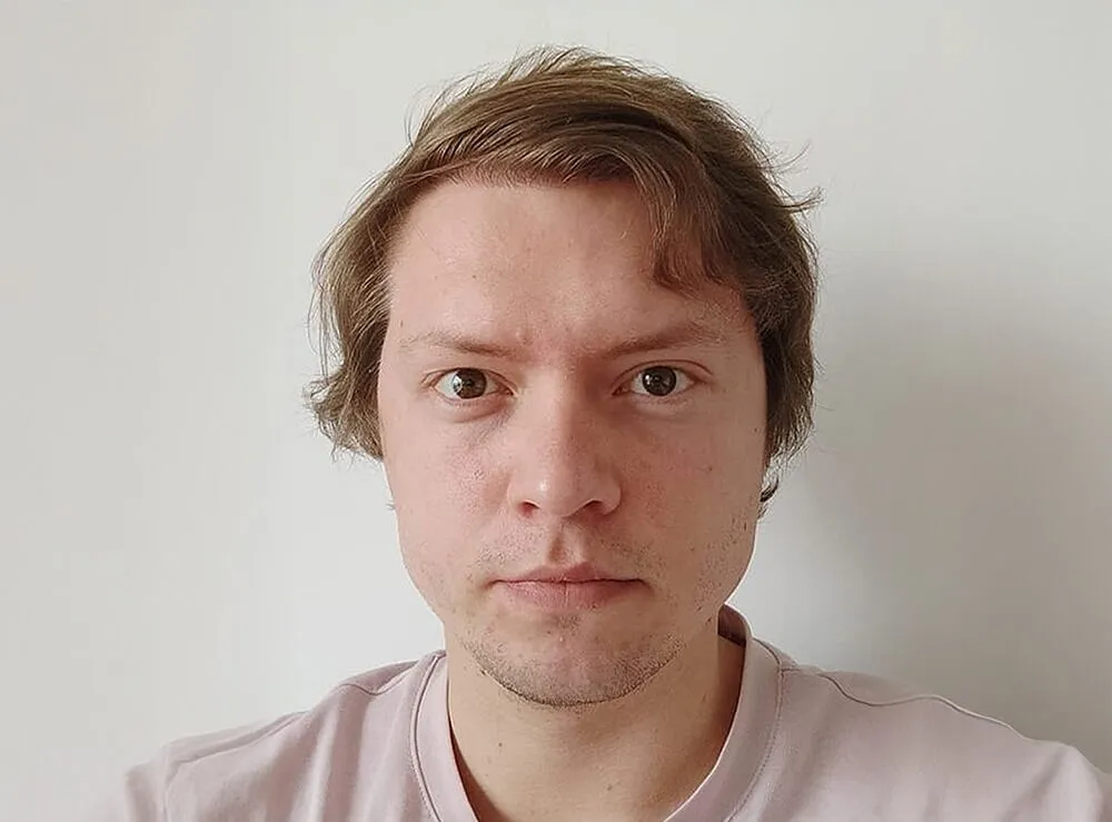 hair-transplant-after-3100-grafts