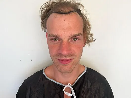 hair-transplant-before-2700-grafts