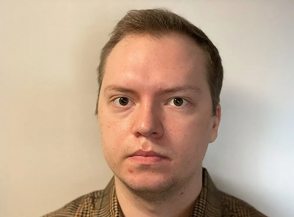 hair-transplant-before-3100-grafts